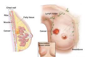 mencegah penyakit kanker payudara